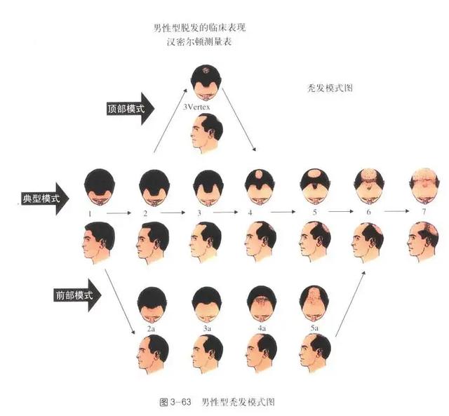 脫發(fā)研究最新進展，頭頂希望與友情力量驅(qū)動下的探索